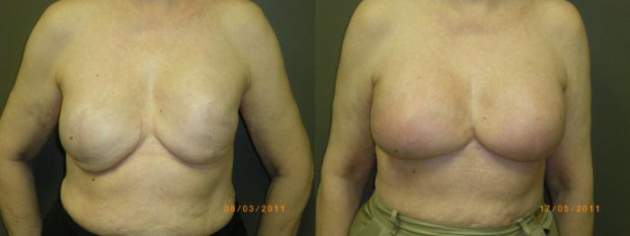 Breast Reconstruction Before & After Photos Patient 156, Marietta, GA