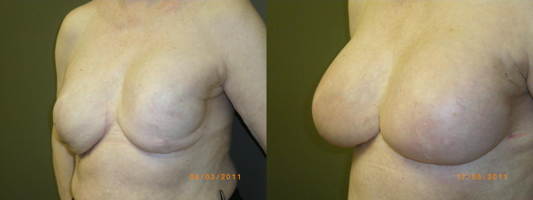 Mastectomy reconstruction after double breast Breast Reconstruction