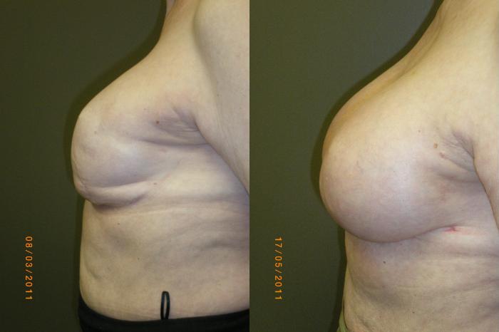 Breast Reconstruction Before & After Photos Patient 156, Marietta, GA