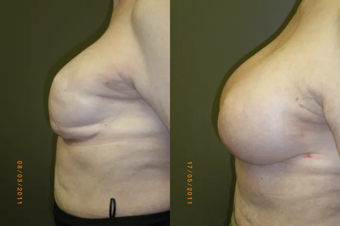 Breast Reconstruction Before & After Photos Patient 156