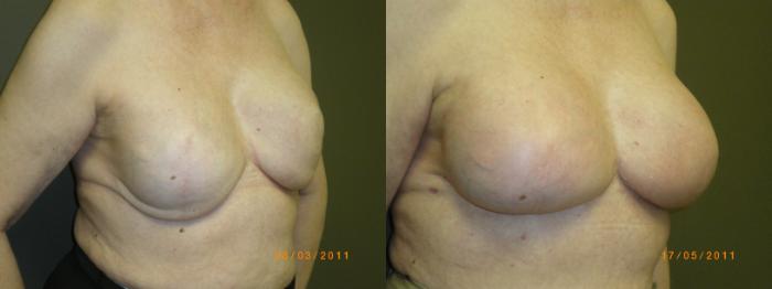 Breast Reconstruction Before & After Photo | Marietta, GA | Plastic Surgery Center of the South