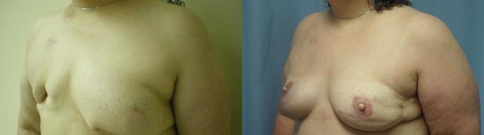 Breast Reconstruction Before & After Photo | Atlanta, GA | Plastic Surgery Center of the South