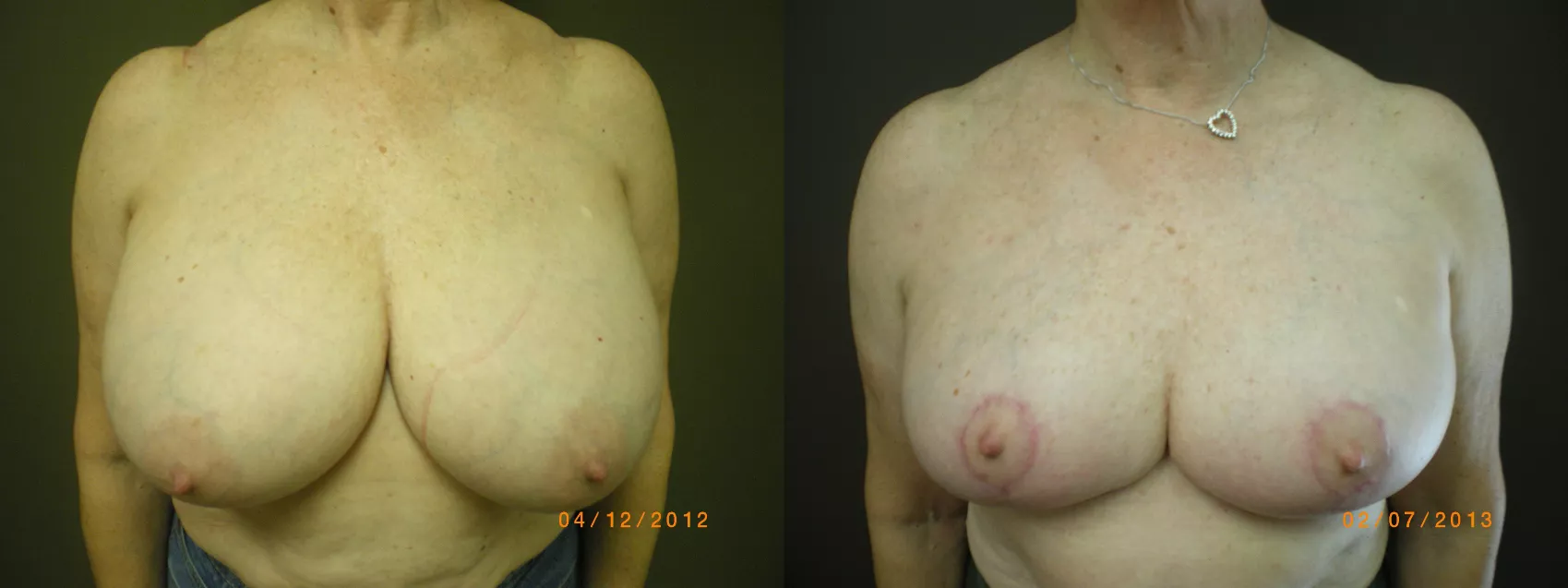 Breast Reduction Before & After Photos Patient 178 | Atlanta, GA | Plastic  Surgery Center of the South