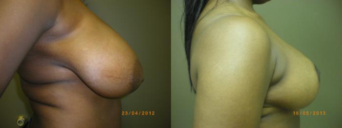 Breast Reduction Before & After Photo | Marietta, GA | Plastic Surgery Center of the South