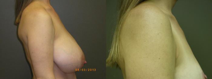 Breast Reduction Before & After Photo | Atlanta, GA | Plastic Surgery Center of the South