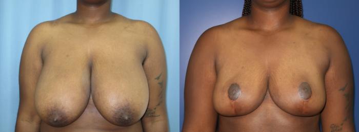 Breast Reduction Before & After Photo | Atlanta, GA | Plastic Surgery Center of the South