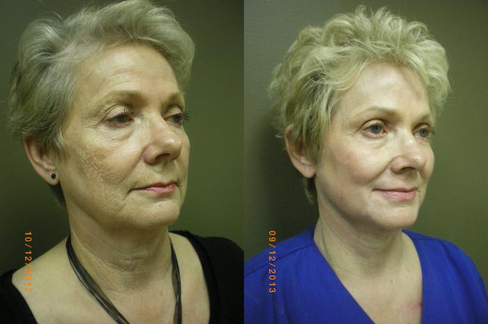 CO2 Laser (Skin Resurfacing) Before & After Photo | Marietta, GA | Plastic Surgery Center of the South