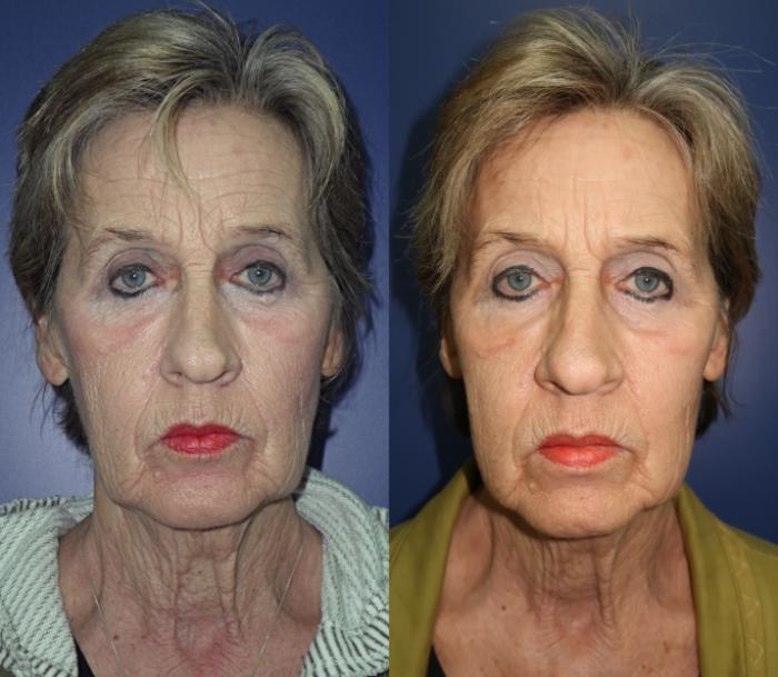 CO2 Laser (Skin Resurfacing) Before & After Photo | Marietta, GA | Plastic Surgery Center of the South