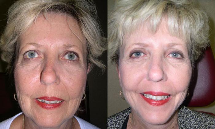 CO2 Laser (Skin Resurfacing) Before & After Photo | Atlanta, GA | Plastic Surgery Center of the South