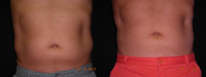 CoolSculpting® Before & After Photo | Atlanta, GA | Plastic Surgery Center of the South