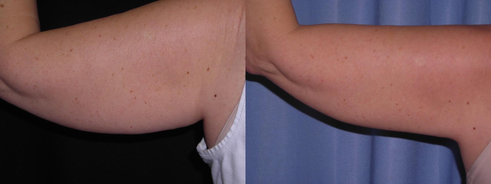 CoolSculpting® Before & After Photo | Marietta, GA | Plastic Surgery Center of the South