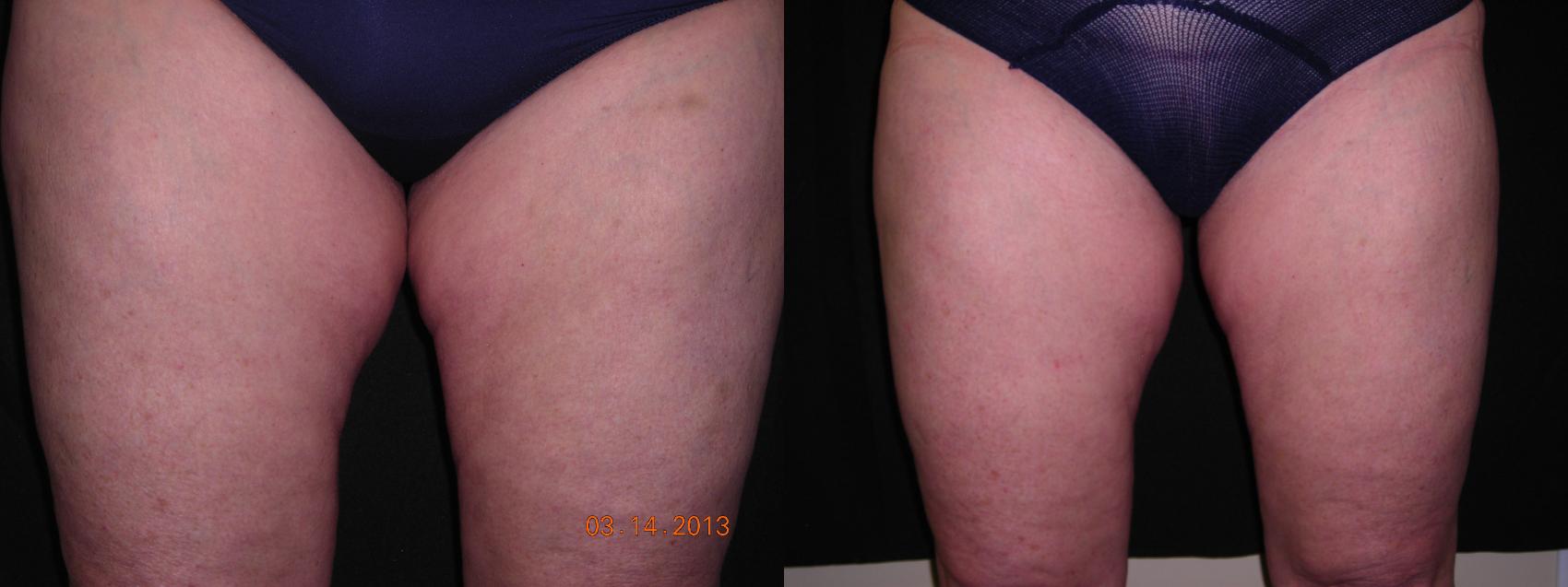 CoolSculpting® Before & After Photo | Marietta, GA | Plastic Surgery Center of the South