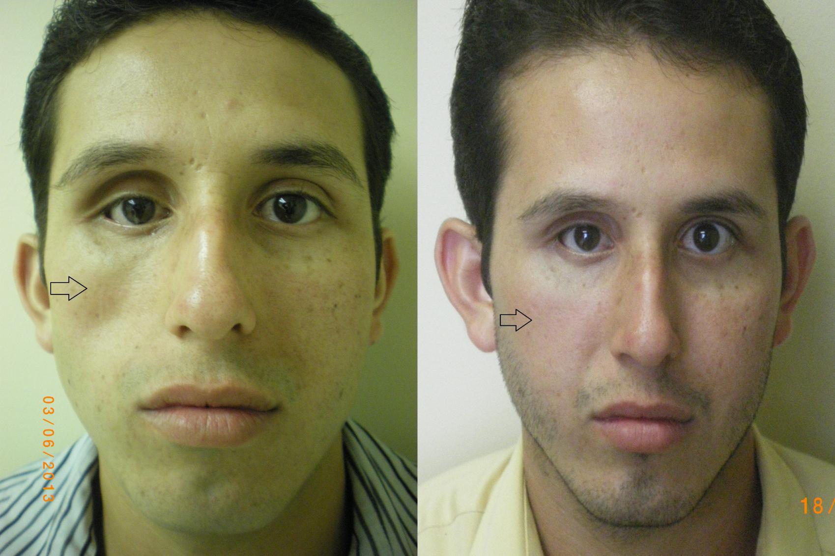 Dermal Fillers Before & After Photo | Atlanta, GA | Plastic Surgery Center of the South