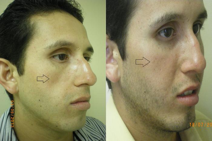 Dermal Fillers Before & After Photo | Atlanta, GA | Plastic Surgery Center of the South