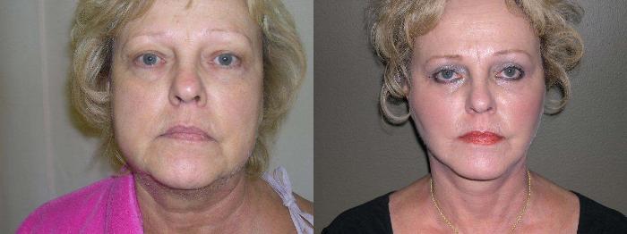 Facelift Before & After Photo | Marietta, GA | Plastic Surgery Center of the South