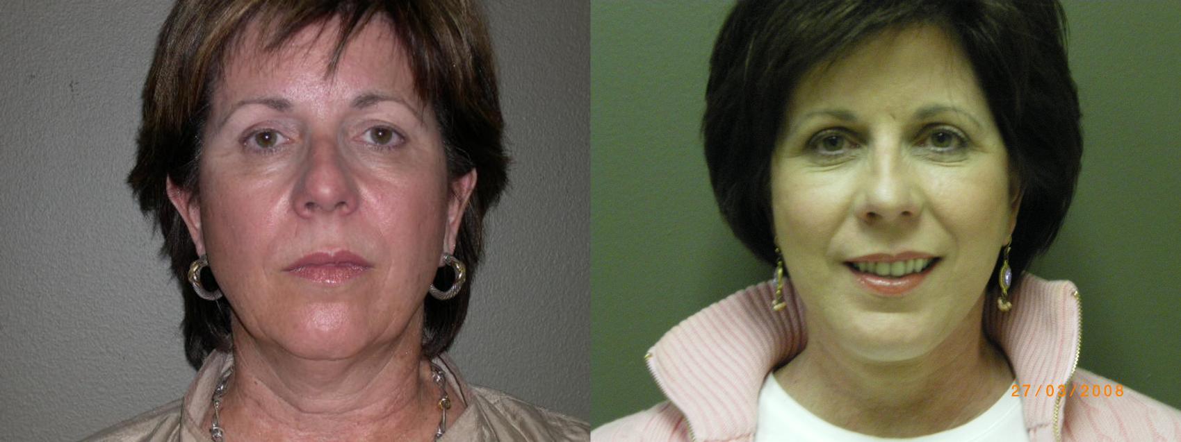 Facelift Before & After Photo | Marietta, GA | Plastic Surgery Center of the South