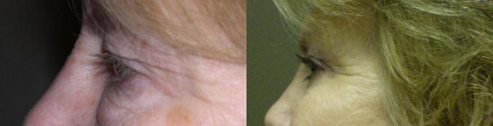 Mini Facelift Before and After Pictures Case 770