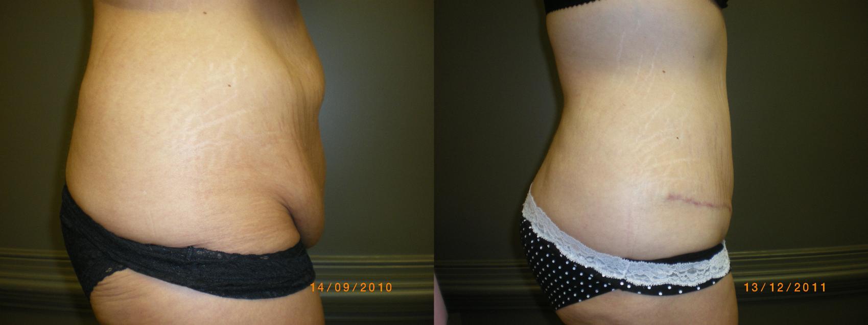 Liposuction Before & After Photo | Atlanta, GA | Plastic Surgery Center of the South