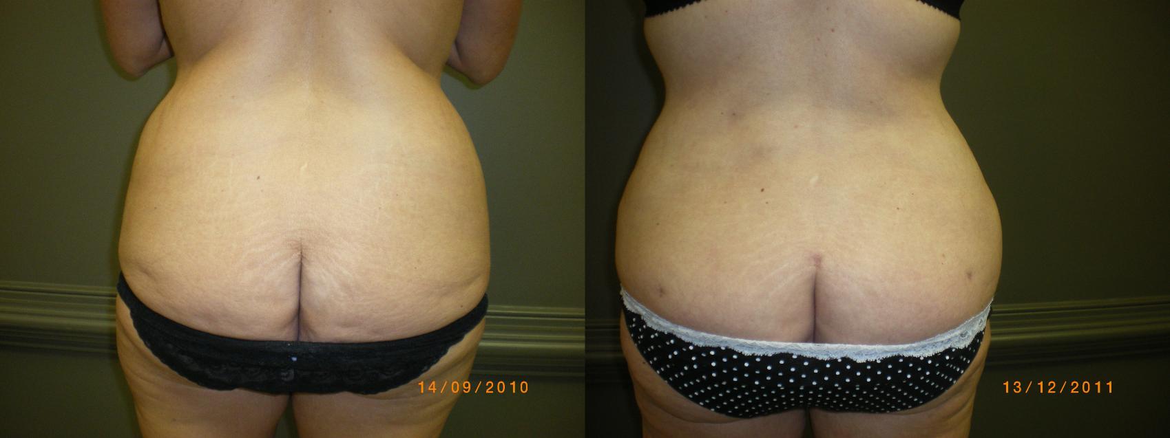 Liposuction Before & After Photo | Atlanta, GA | Plastic Surgery Center of the South