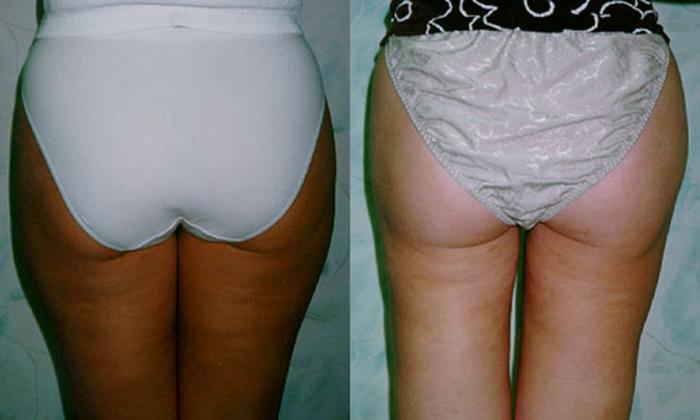 Liposuction Before & After Photo | Marietta, GA | Plastic Surgery Center of the South