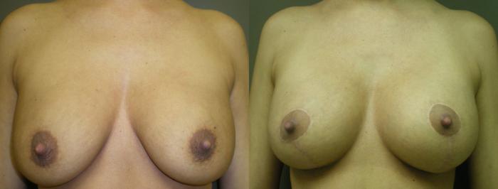 Liposuction Before & After Photo | Marietta, GA | Plastic Surgery Center of the South