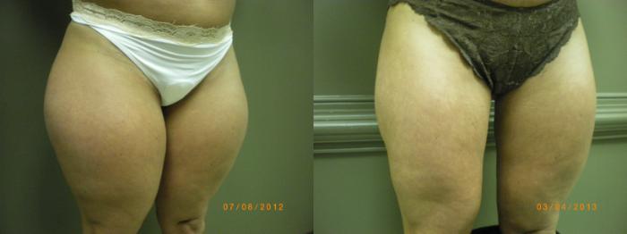 Liposuction Before and After Pictures Case 176