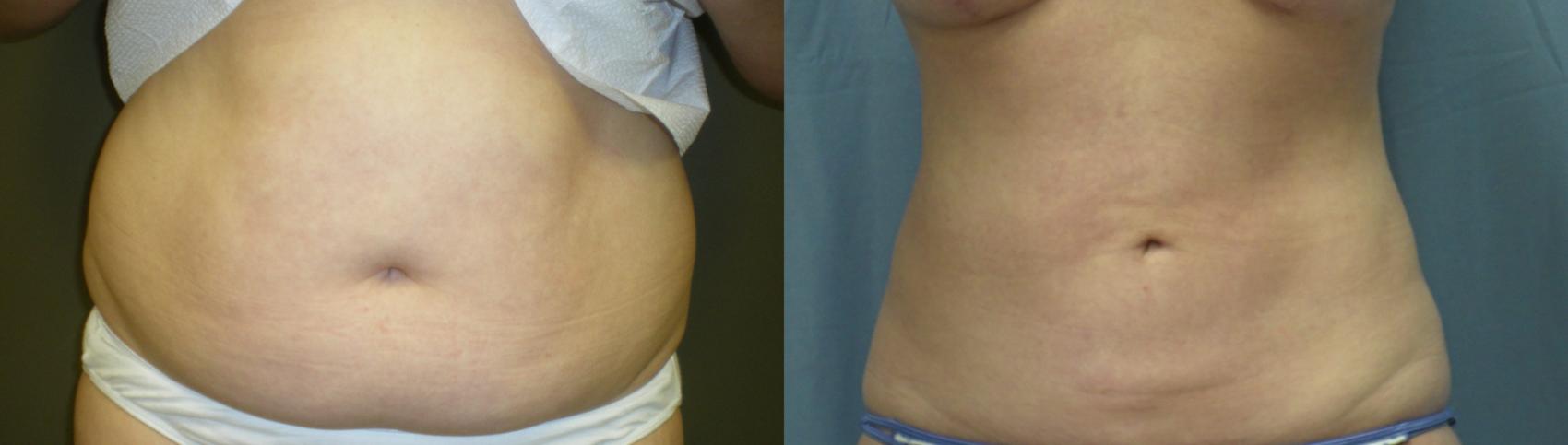Asymmetrical Breasts - Atlanta Liposuction Specialty Clinic