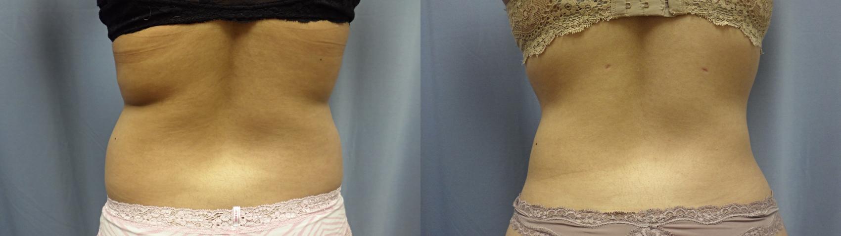 Liposuction Before & After Photo | Atlanta, GA | Plastic Surgery Center of the South