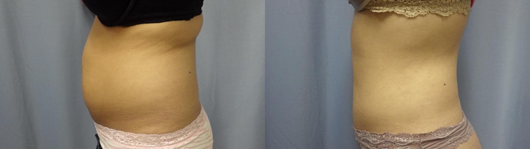 Liposuction Before & After Photo | Atlanta, GA | Plastic Surgery Center of the South