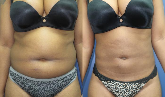 Liposuction Before & After Photo Gallery, Marietta, GA