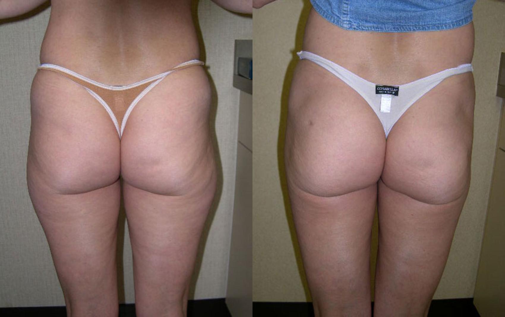 Liposuction Before & After Photo | Atlanta, GA | Plastic Surgery Center of the South