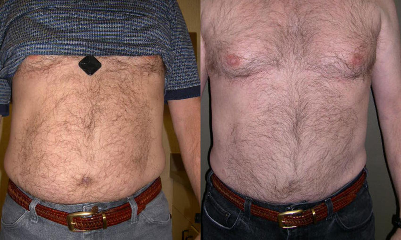 Liposuction Before & After Photo | Atlanta, GA | Plastic Surgery Center of the South
