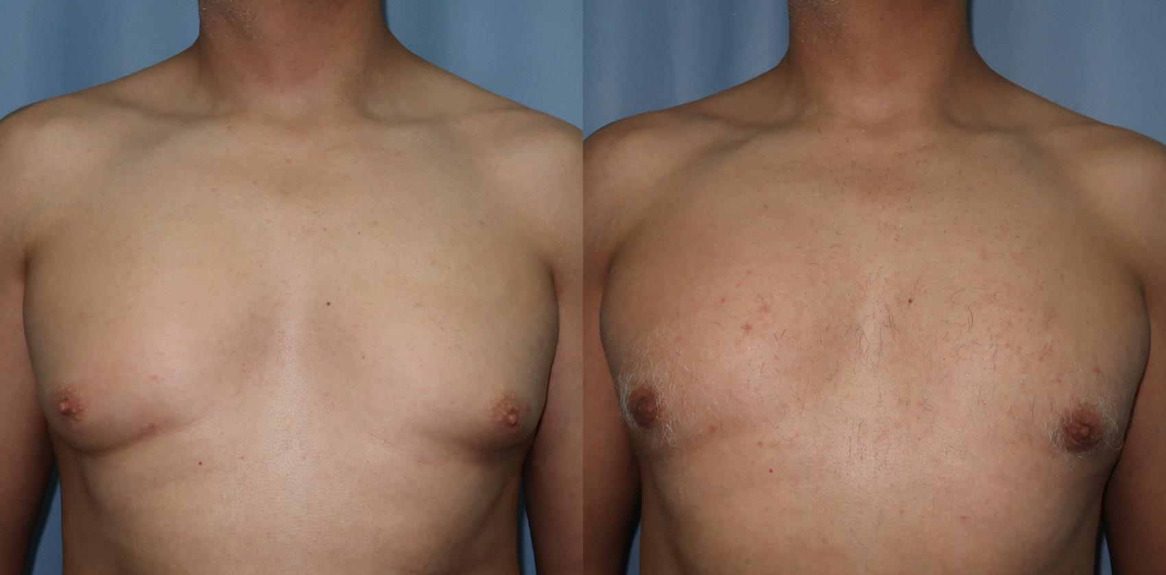 Male Breast Reduction Before & After Photo | Marietta, GA | Plastic Surgery Center of the South
