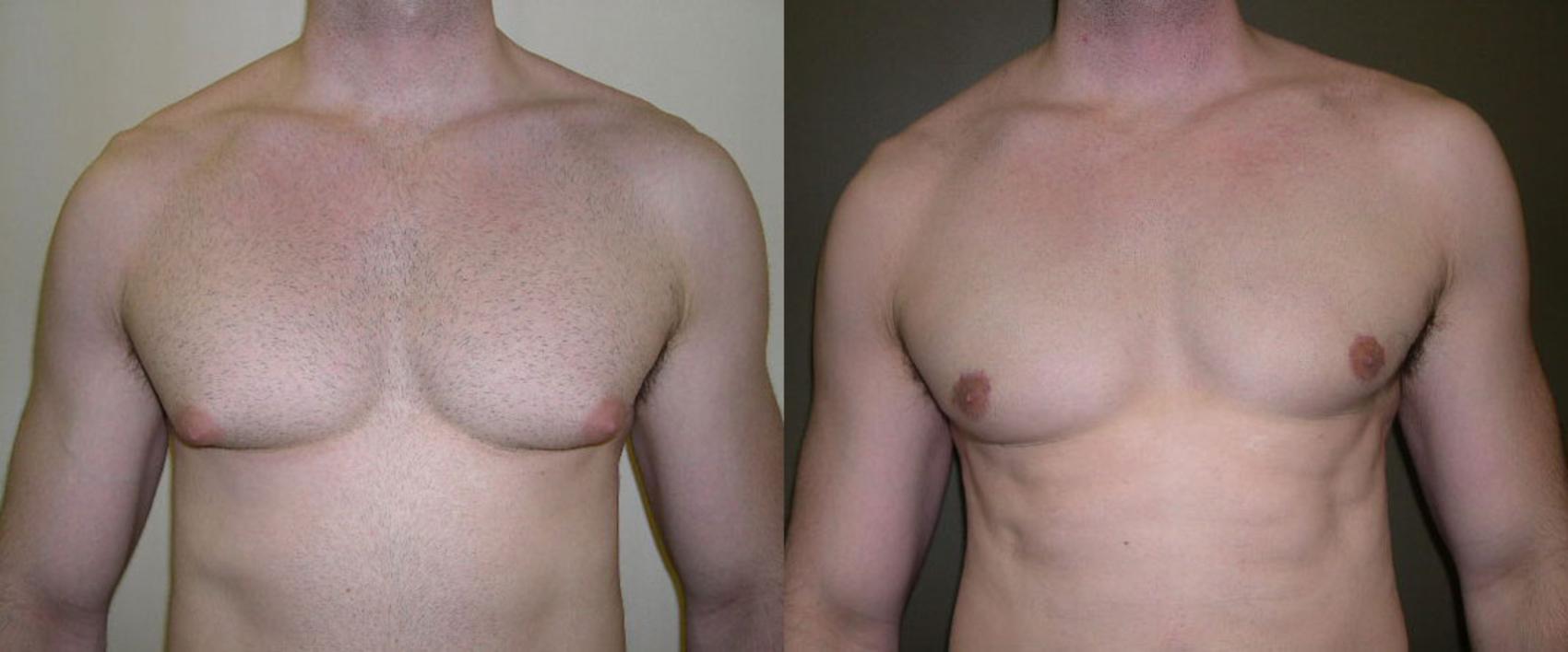 Male Breast Reduction Before & After Photo | Atlanta, GA | Plastic Surgery Center of the South
