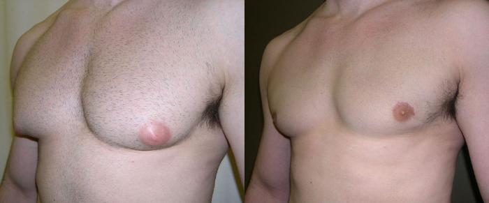 Male Breast Reduction Before & After Photo | Atlanta, GA | Plastic Surgery Center of the South