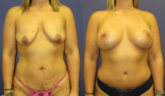 Mommy Makeover Before & After Photo | Atlanta, GA | Plastic Surgery Center of the South