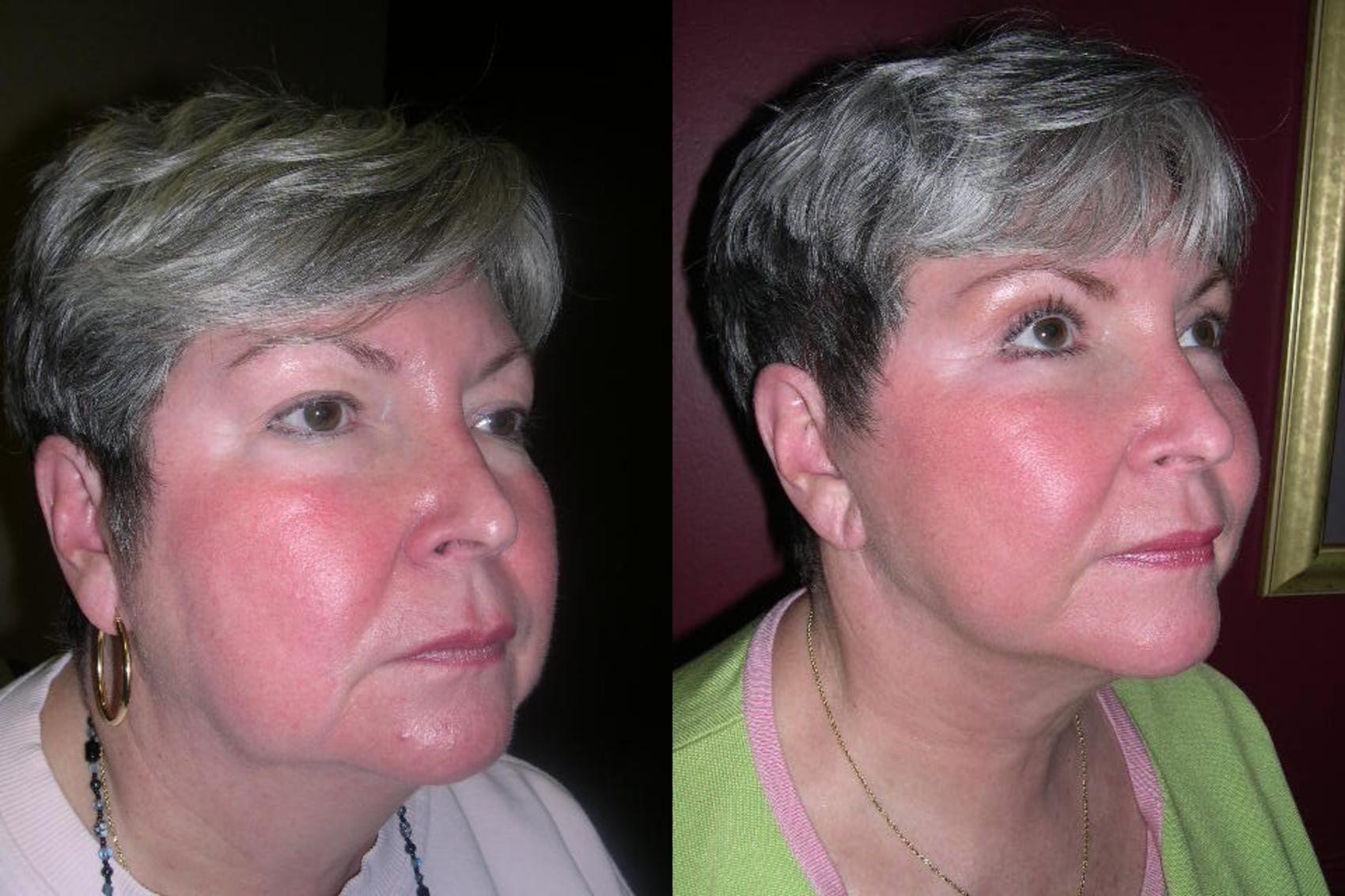 Neck Lift Before & After Photo | Marietta, GA | Plastic Surgery Center of the South