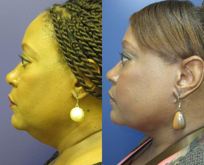 Neck Lift Before & After Photo | Atlanta, GA | Plastic Surgery Center of the South