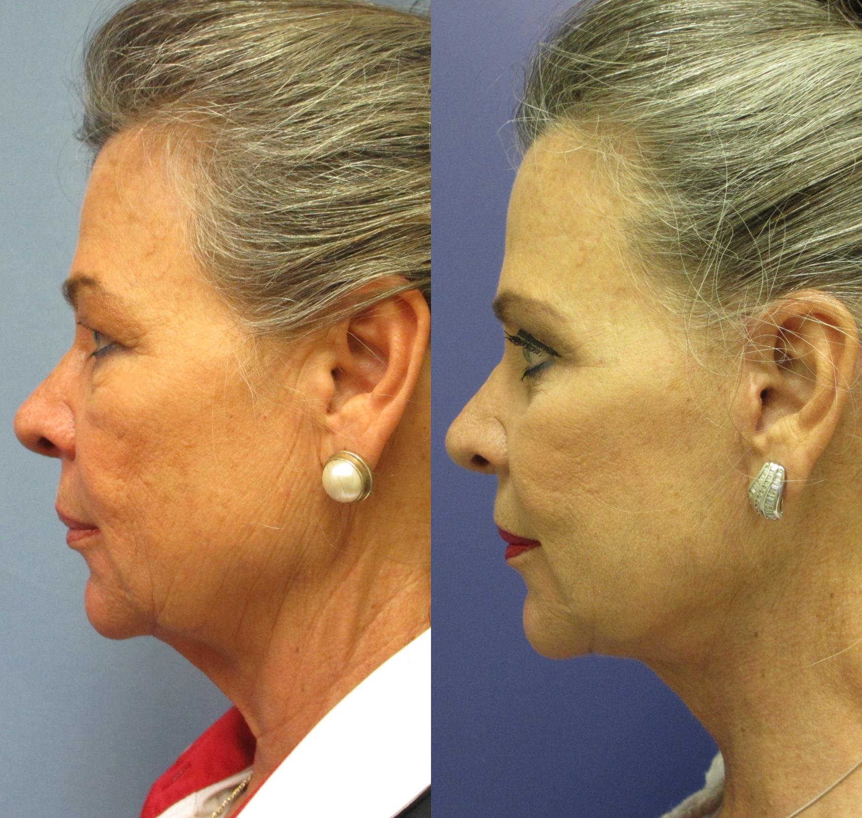 Neck Lift Before & After Photo | Marietta, GA | Plastic Surgery Center of the South