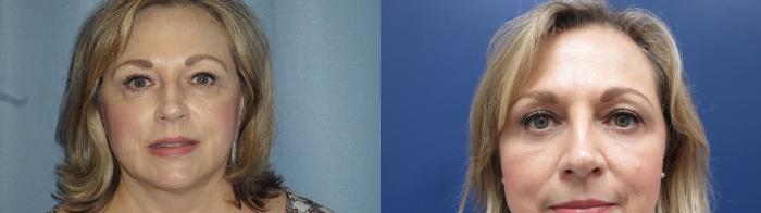 Neck Lift Before & After Photo | Atlanta, GA | Plastic Surgery Center of the South