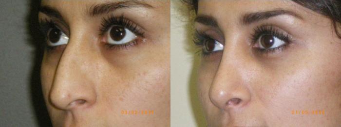 Rhinoplasty (Nose Surgery) Before & After Photo | Marietta, GA | Plastic Surgery Center of the South