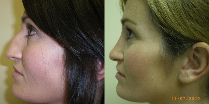 Rhinoplasty (Nose Surgery) Before & After Photo | Atlanta, GA | Plastic Surgery Center of the South