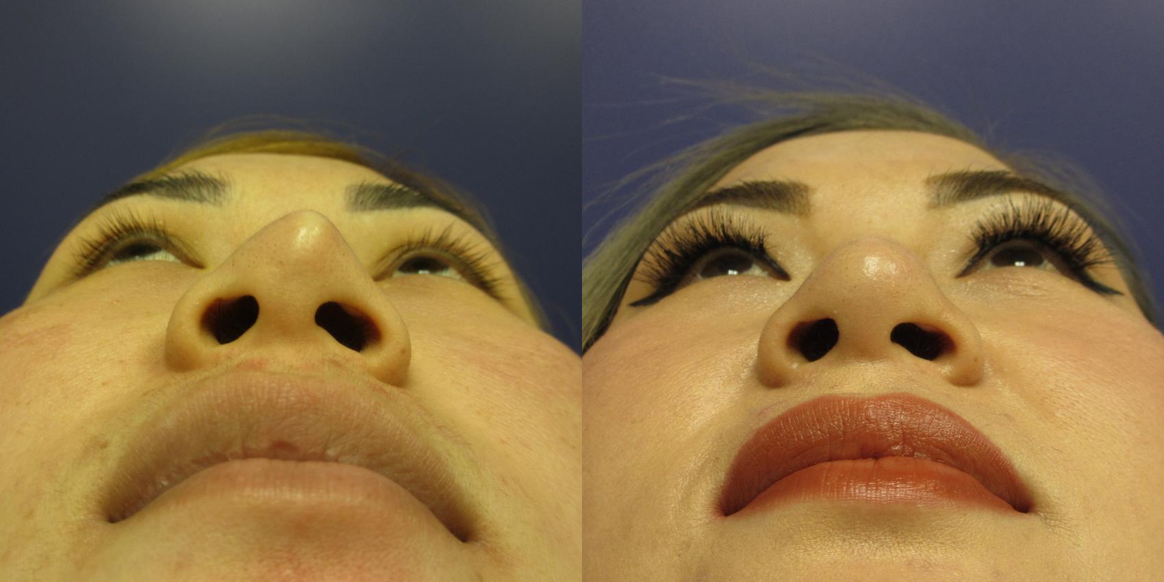 Removal of silicone nasal implant