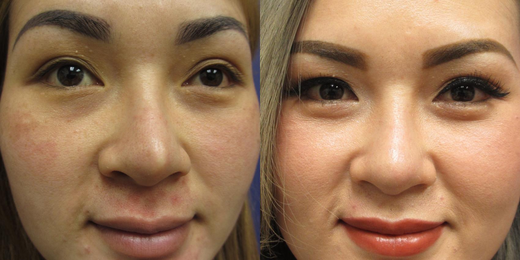 Removal of silicone nasal implant