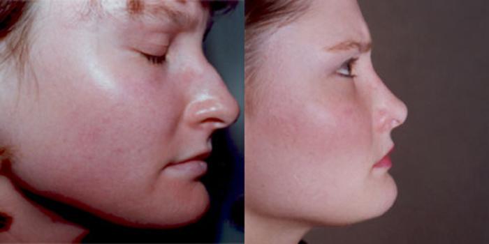 Rhinoplasty (Nose Surgery) Before & After Photo | Atlanta, GA | Plastic Surgery Center of the South