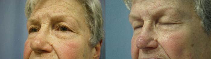 Skin Cancer Reconstruction Before & After Photo | Atlanta, GA | Plastic Surgery Center of the South