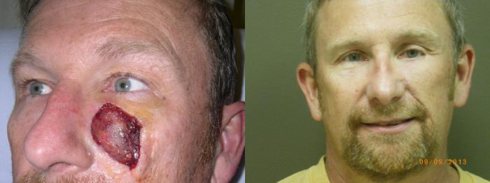 Skin Cancer Reconstruction Before & After Photo | Atlanta, GA | Plastic Surgery Center of the South