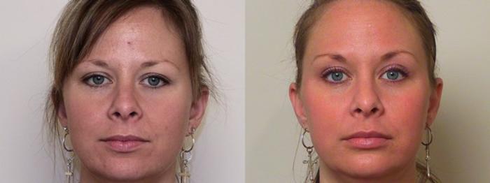 Skin Care Before & After Photo | Marietta, GA | Plastic Surgery Center of the South