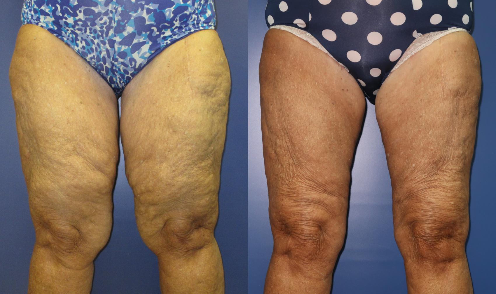 Thigh Lift Surgery Before and After Pictures